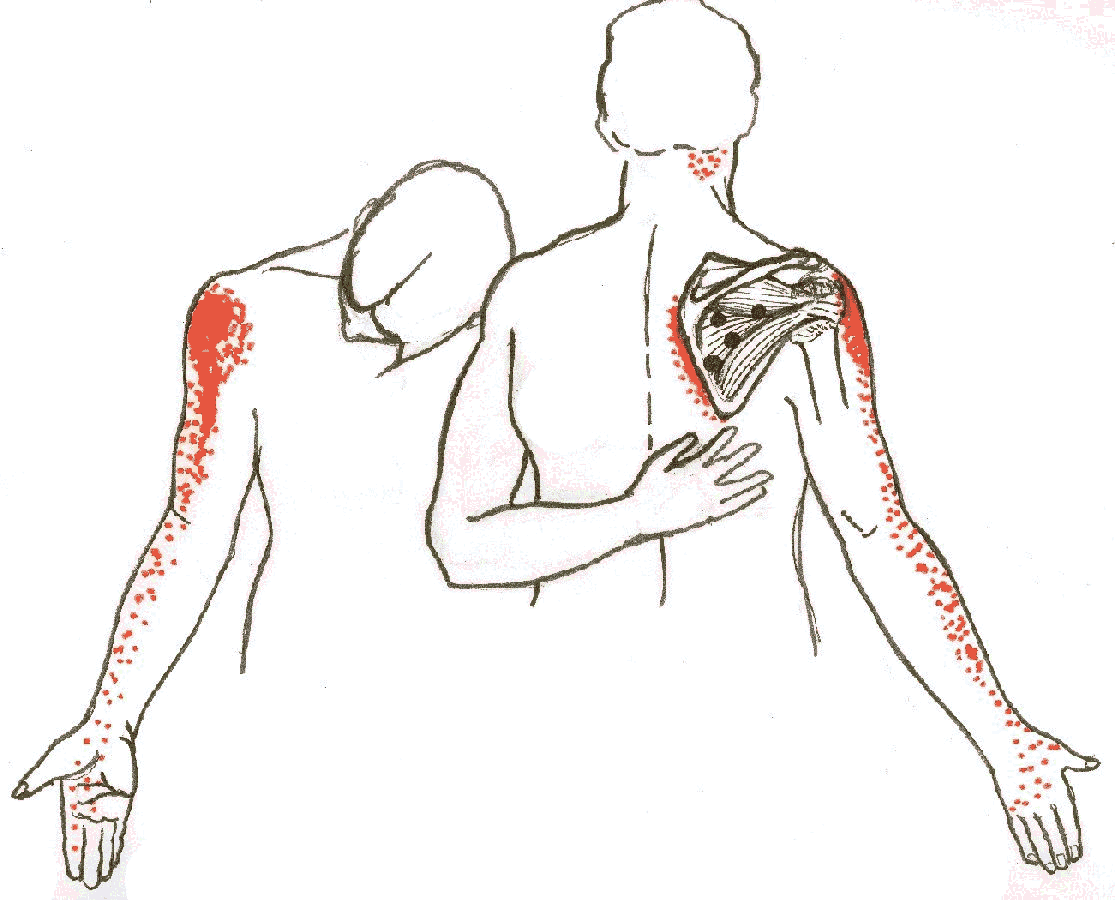 Infraspinatus Pain