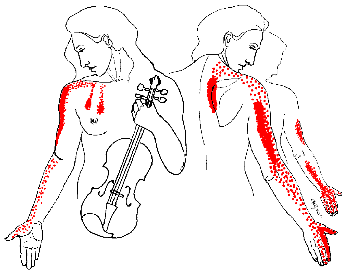 Upper Back Trigger Points Chart